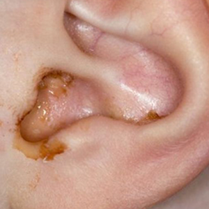 Ear Infections